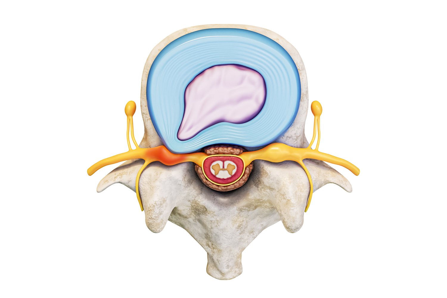 Illustration looking down through a lumbar vertebra from above: the disc's outer rings in blue, the soft centre pushed backwards through the wall, and the nerve root inflamed red-orange where the disc reaches it.