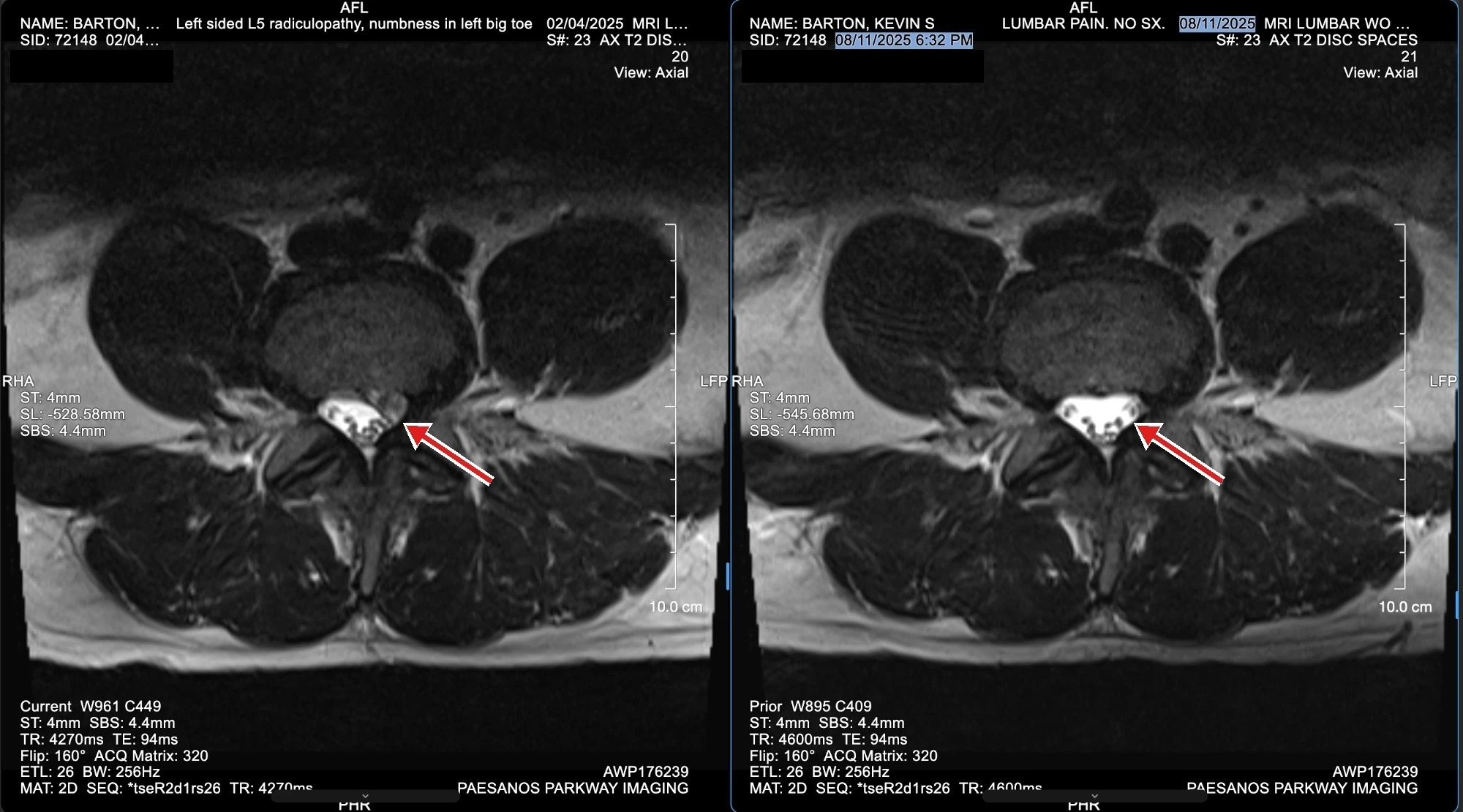 Dr. Barton's own lumbar MRI in cross-section at L4-L5. Left, February 2025: the extrusion marked against the left nerve root. Right, August 2025: the same level after his course on the DRX9000.