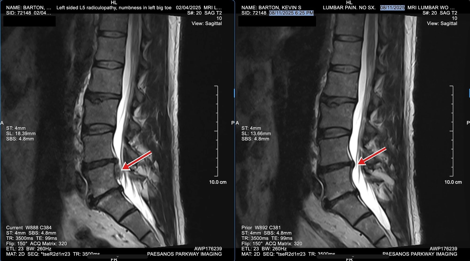 Dr. Barton's own lumbar MRI, side view. Left, February 2025: a red arrow marks a large L4-L5 disc extrusion pressing into the spinal canal. Right, August 2025: the same level after his course on the DRX9000.