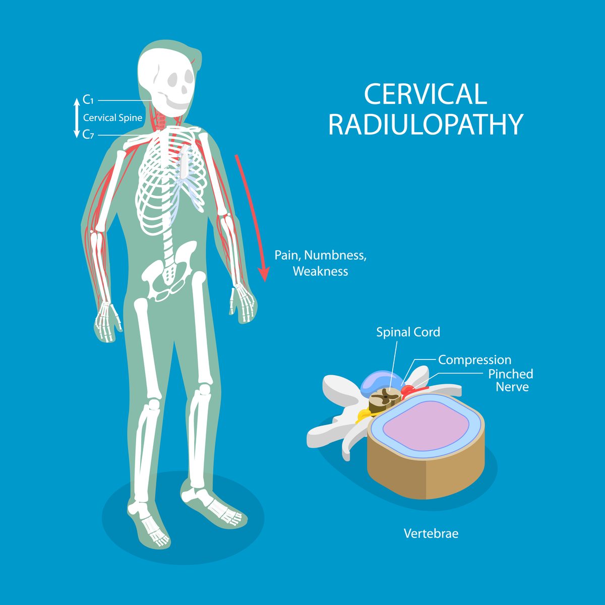 Illustration of cervical radiculopathy: nerves traced from the neck down both arms into the hands, with an inset of a vertebra showing a disc pressing on a nerve root.