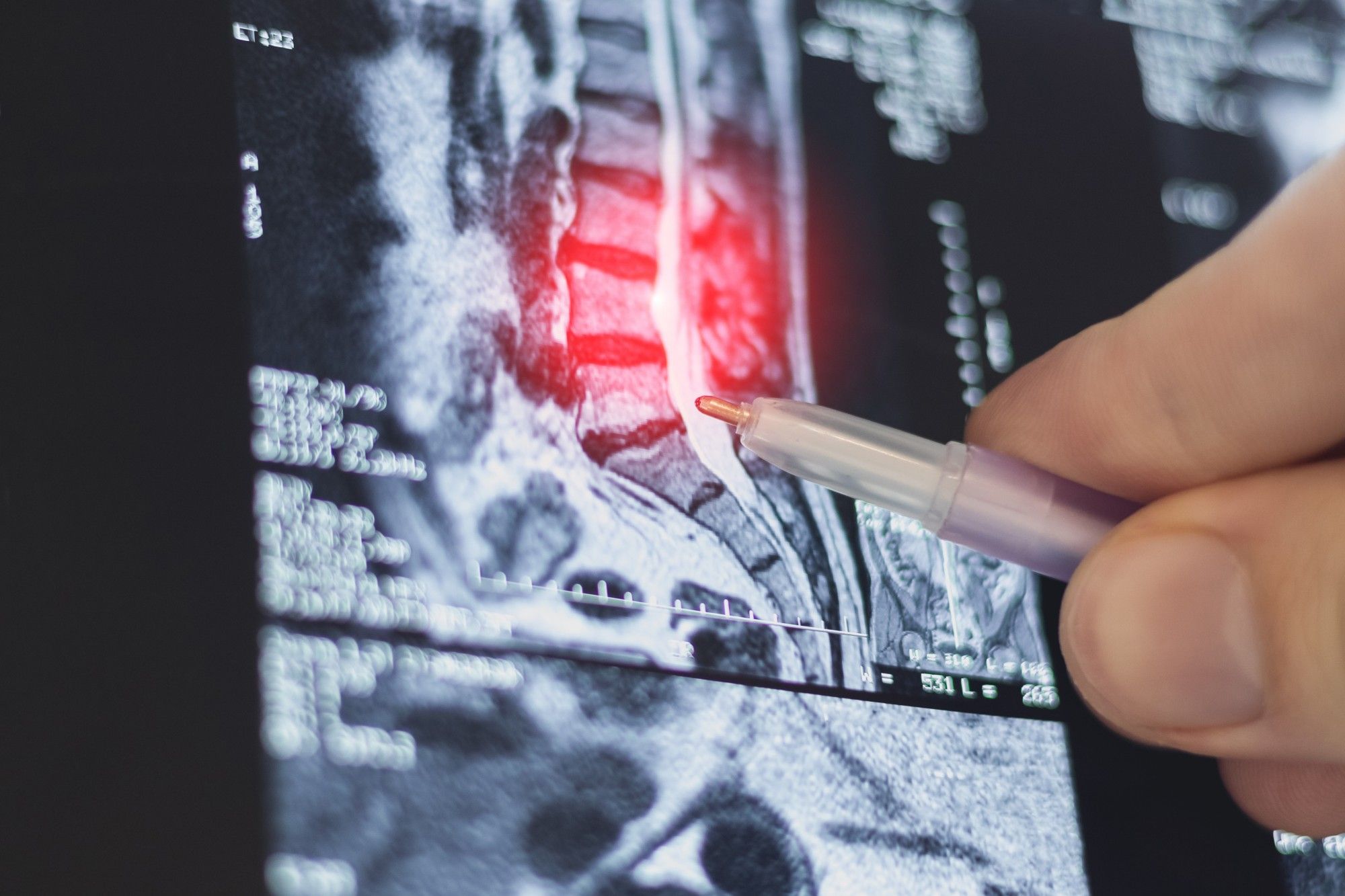 A pen pointing at a lumbar MRI on screen, with the worn disc levels highlighted in red.