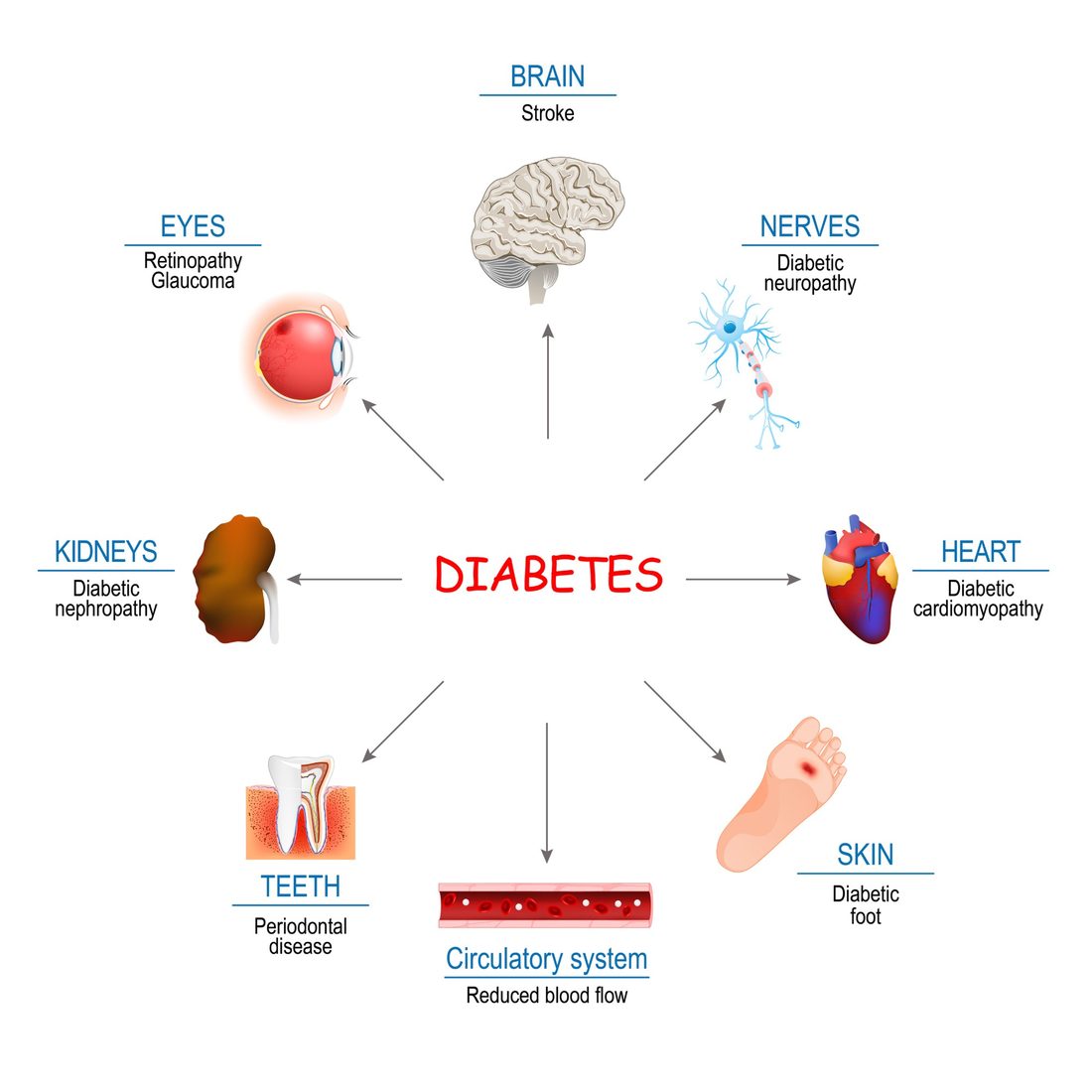 Diagram of the parts of the body diabetes can affect: eyes, brain, nerves, heart, kidneys, teeth, blood vessels with reduced blood flow, and the skin of the feet.