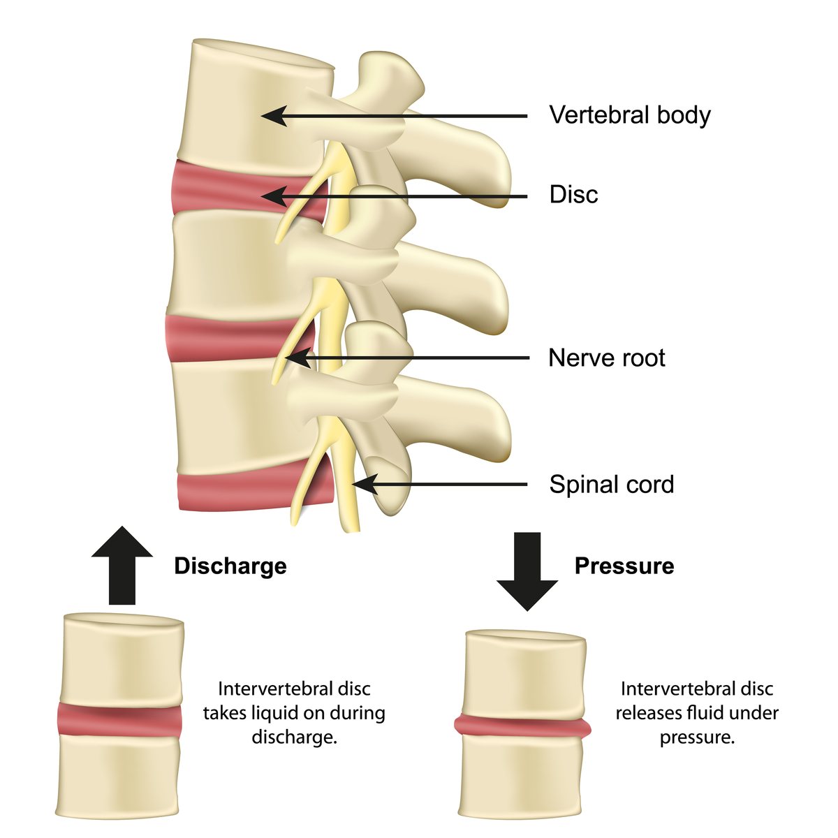 Illustration of lumbar vertebrae, discs, nerve roots and spinal cord, with two smaller diagrams below: a disc taking fluid in when the load comes off, and the same disc releasing fluid under pressure.