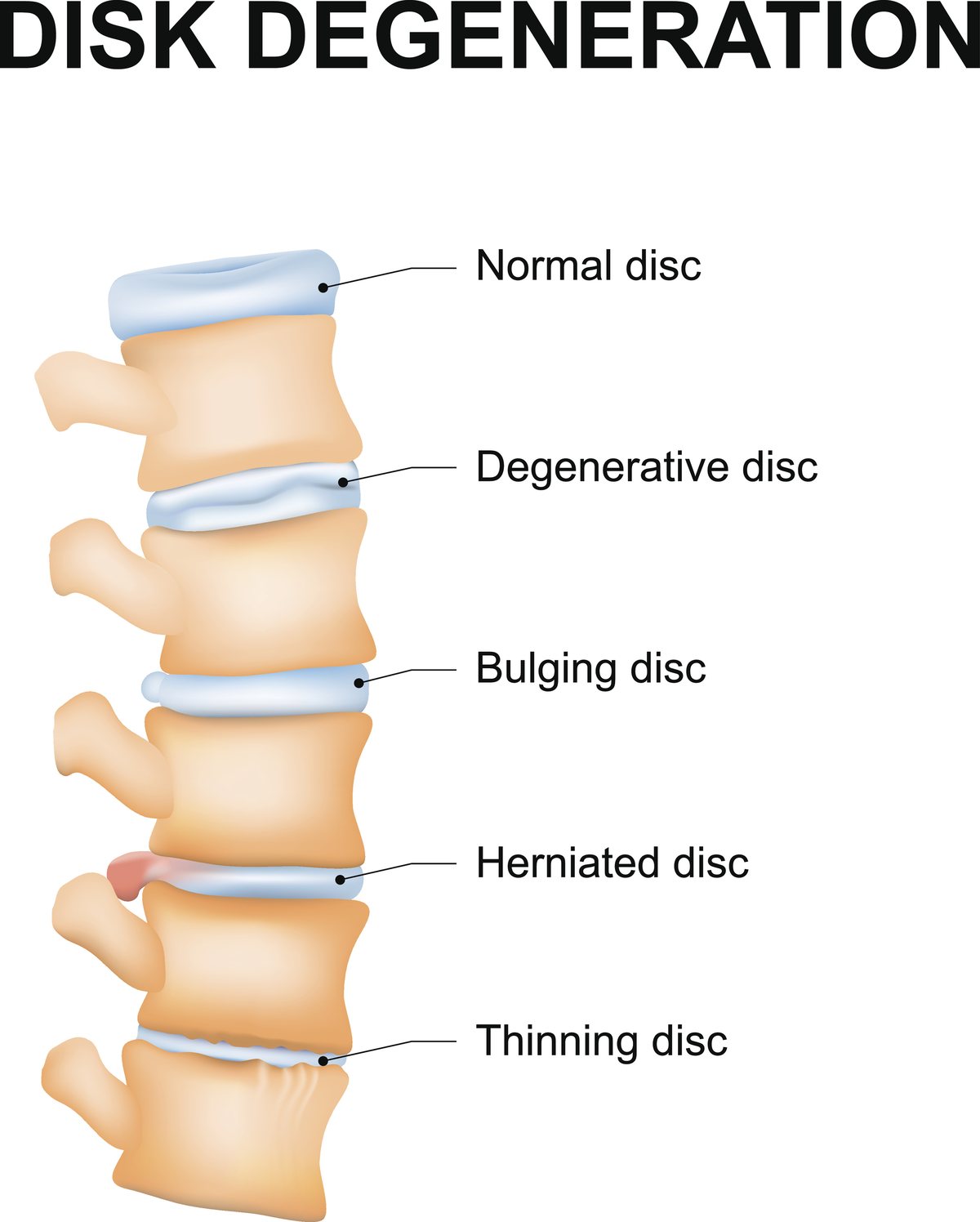 Illustration of a spine from the side showing a normal disc, a degenerative disc, a bulging disc spread evenly past its edge, a herniated disc with material pushed out at one spot, and a thinning disc.