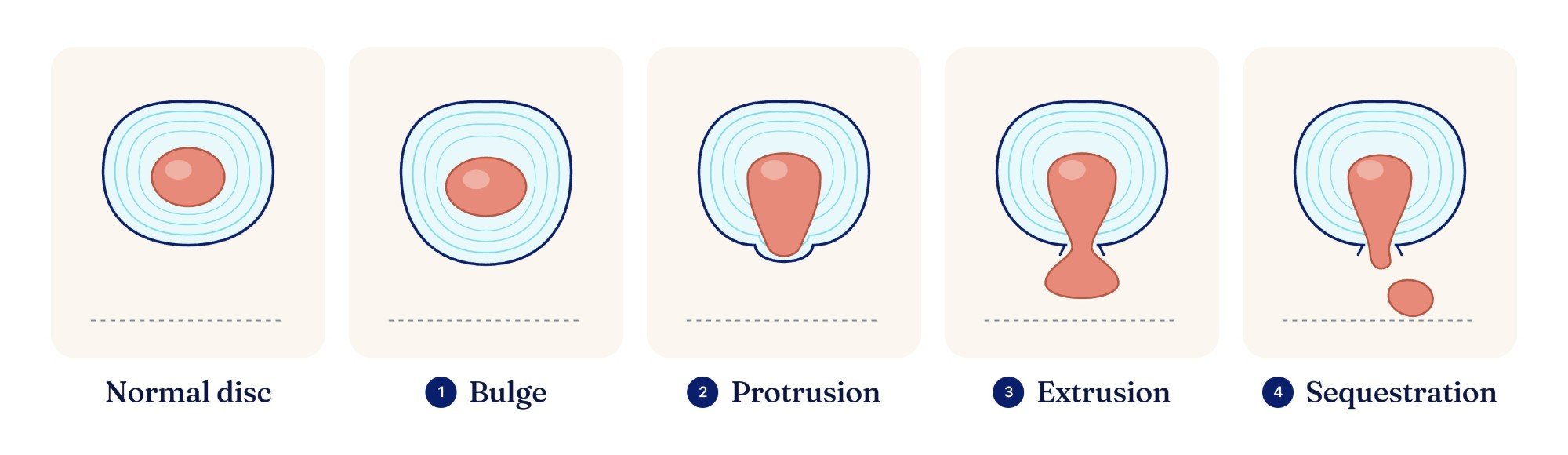 Five disc cross-sections seen from above: a normal disc, then a bulge, a protrusion, an extrusion, and a sequestration where a fragment has broken free.