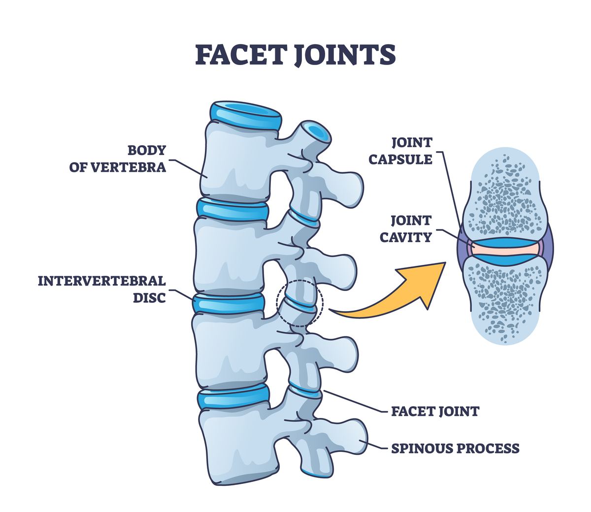 Illustration of the lumbar spine from the side: the vertebral bodies and discs in front, the paired facet joints behind, with an inset showing a single facet joint's capsule and fluid-filled cavity.