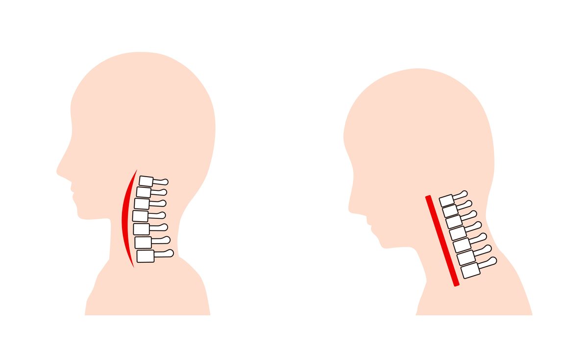 Two side-view illustrations of the neck: on the left the normal forward curve of the cervical spine, on the right the curve straightened with the head carried forward of the shoulders.