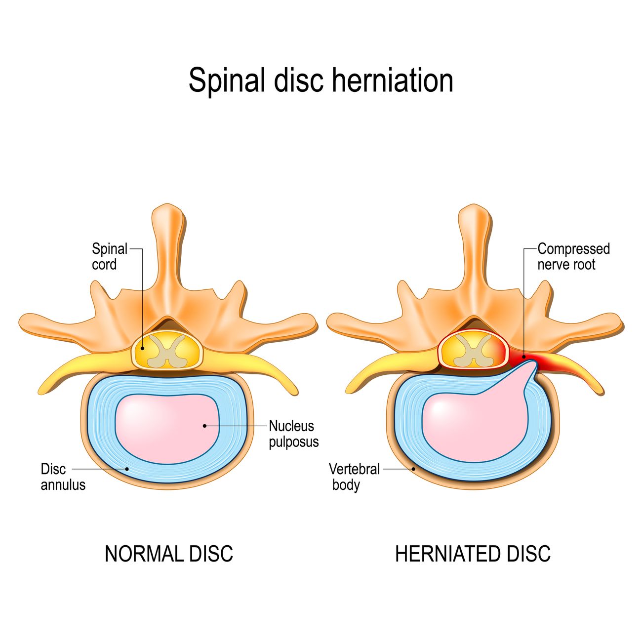 Two-panel illustration looking down through a lumbar vertebra: a normal disc with the nucleus contained, and a herniated disc with the nucleus pushed through the annulus, compressing the nerve root, shown in red.