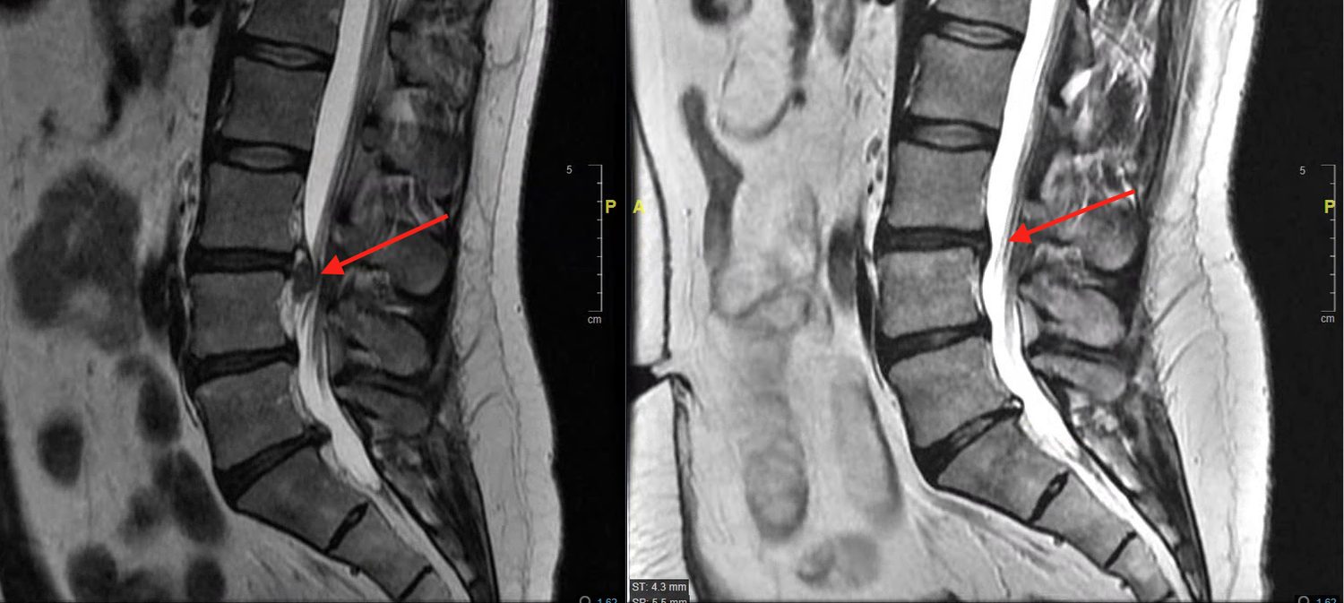 Before-and-after sagittal lumbar MRI scans shown side by side, with the disc visibly reduced in the second scan.