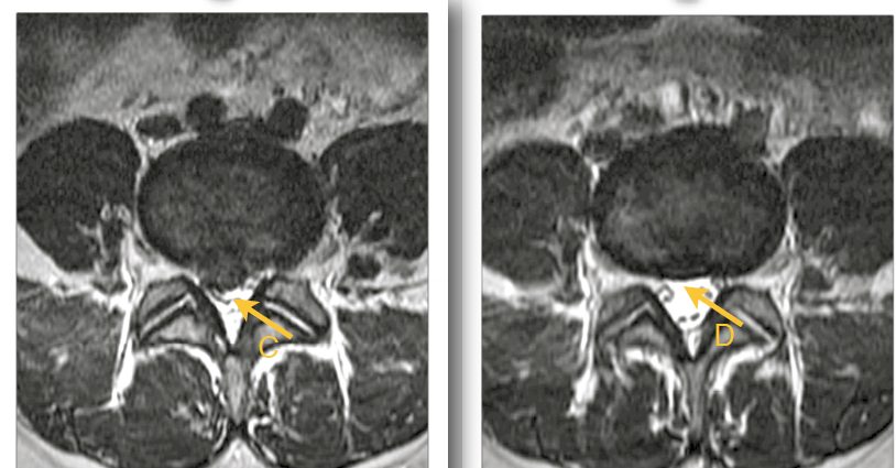 Axial MRI slices of a lumbar disc before and after treatment.