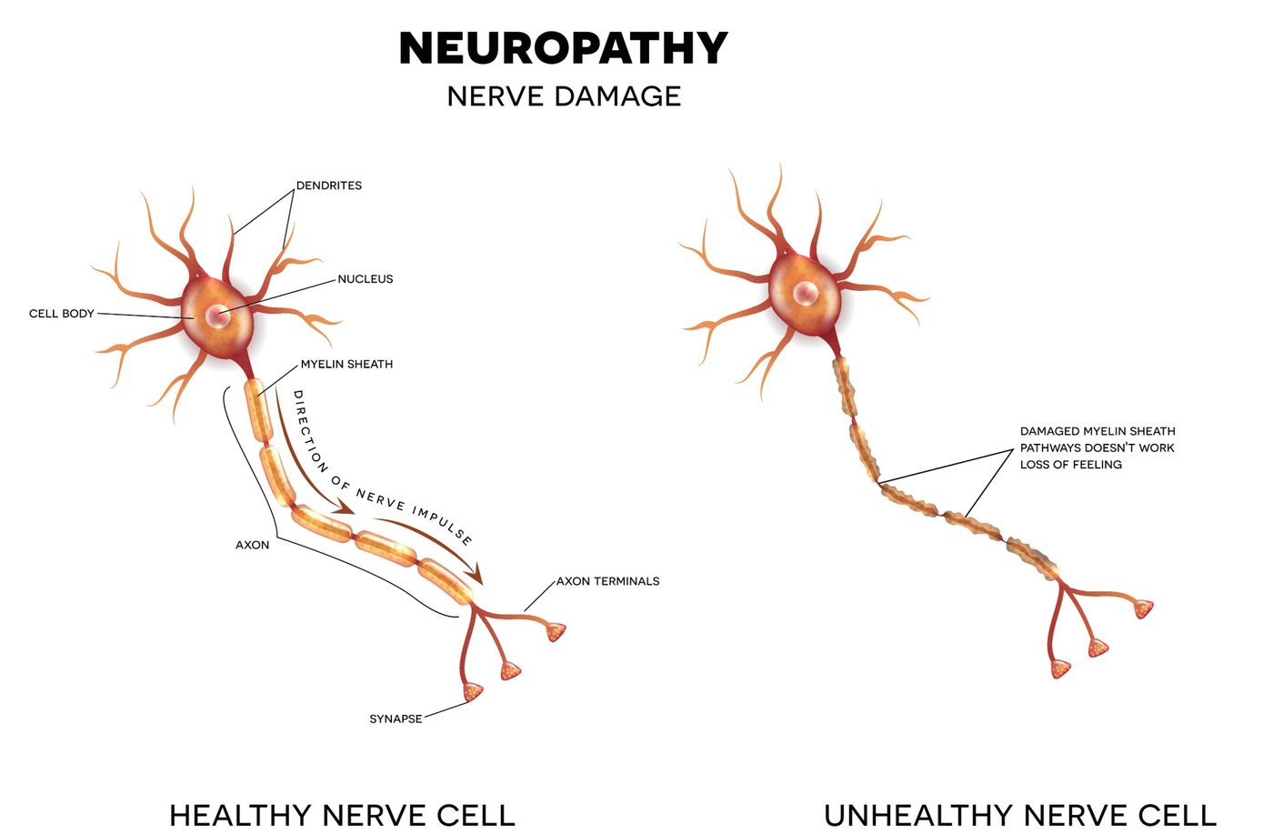 Illustration comparing a healthy nerve cell, with a smooth myelin sheath carrying the nerve impulse along the axon, to an unhealthy nerve cell whose myelin sheath is damaged, so the pathway doesn't work and feeling is lost.