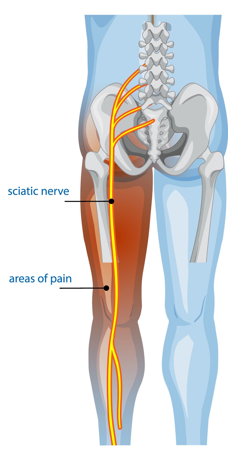 Anatomical illustration of the sciatic nerve leaving the lower spine, passing through the pelvis and running down the back of the leg, with the areas of referred pain shaded.