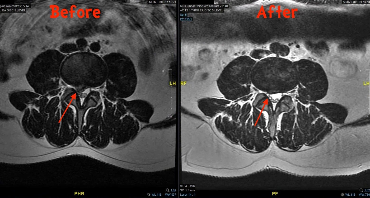 Before-and-after axial lumbar MRI scans of the same patient, seen from above, with a red arrow marking the same spot on each.