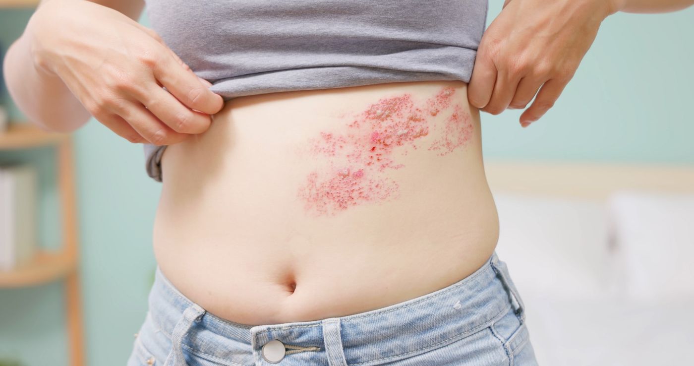A shingles rash forming a band across one side of a woman's upper abdomen.