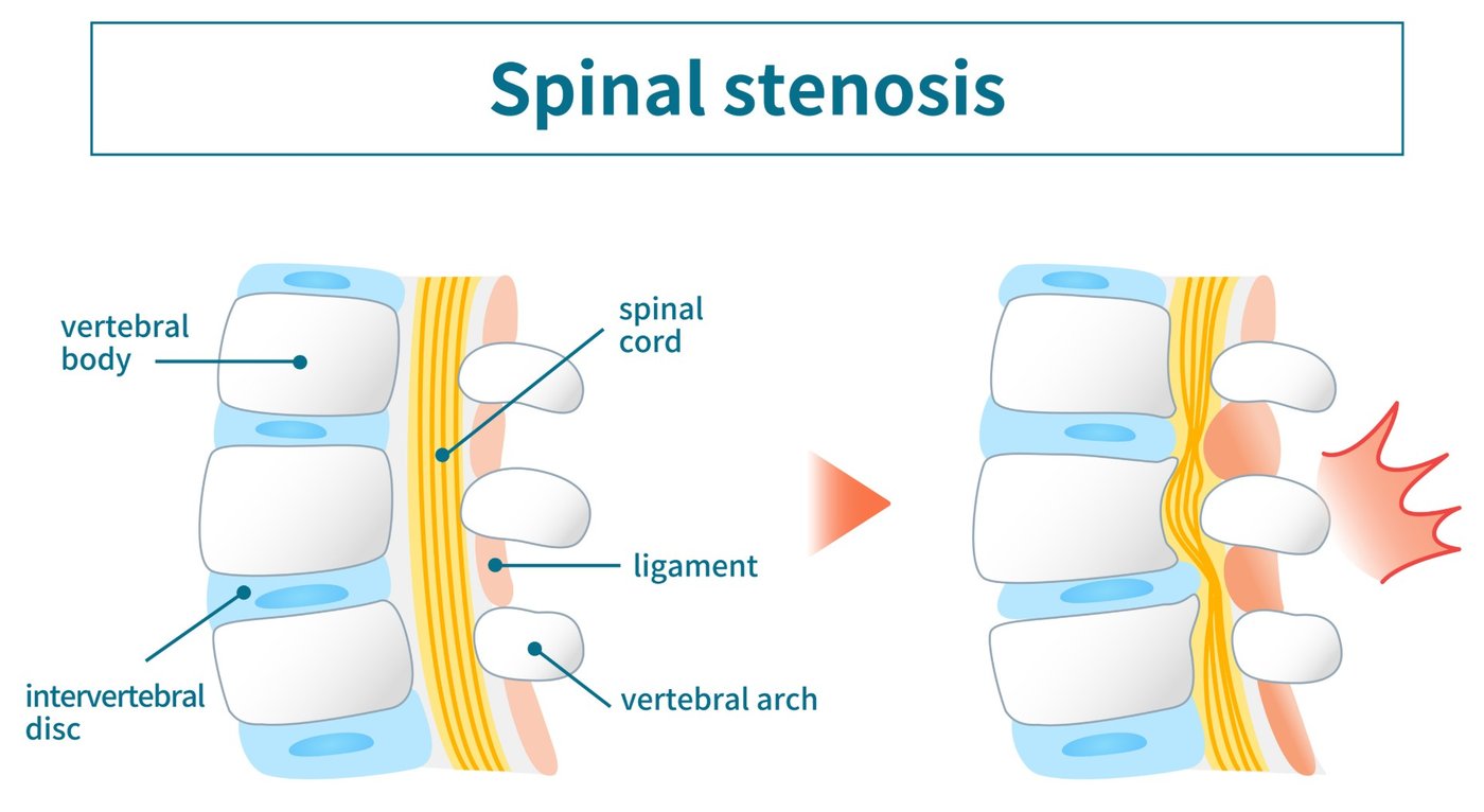 Side-view illustration of the spinal canal. On the left, a healthy canal with room around the nerves. On the right, a bulging disc presses in from the front and a thickened ligament buckles in from behind, squeezing the nerves between them.