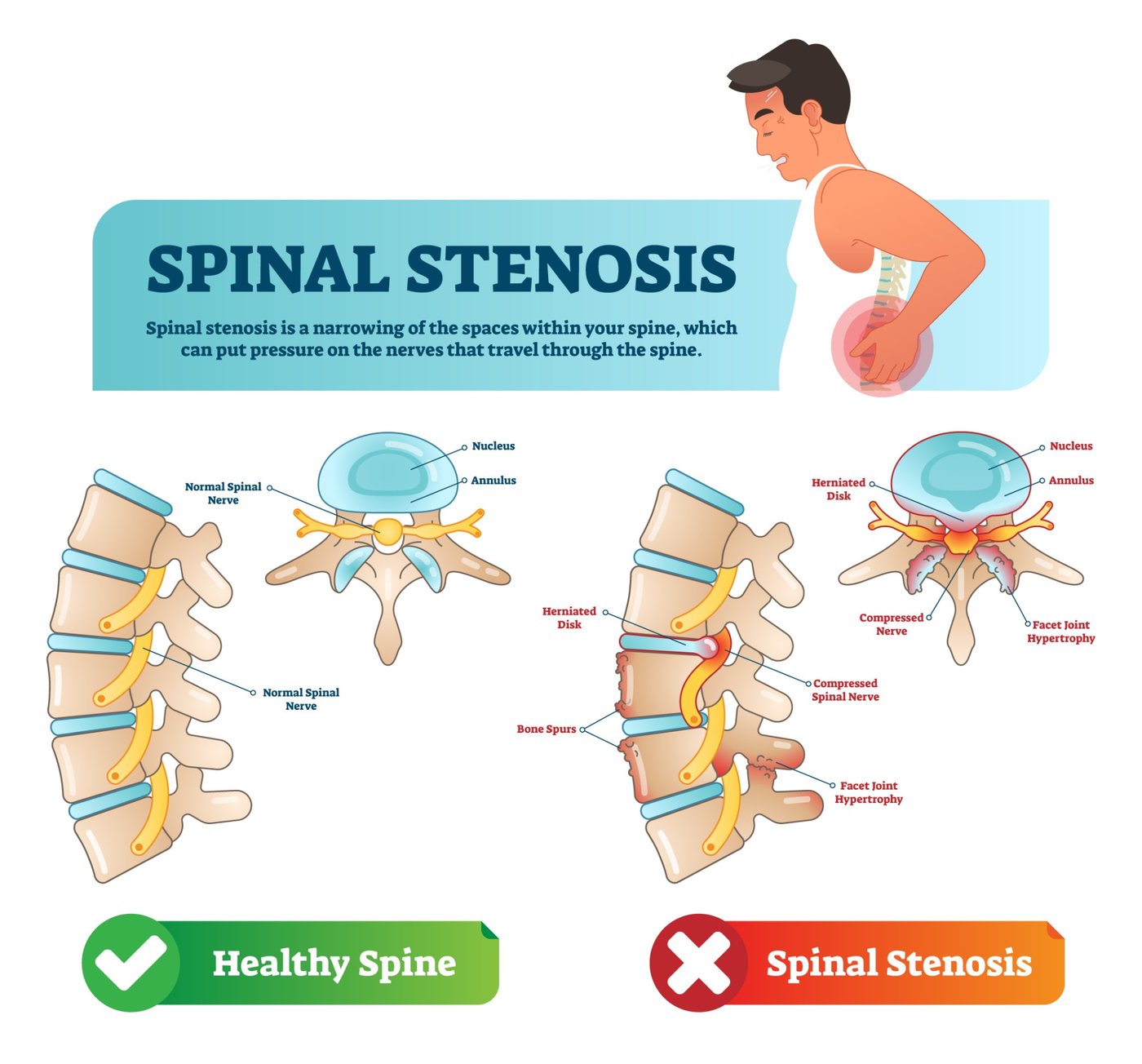 Illustration comparing a healthy lumbar spine with spinal stenosis. On the healthy side, the discs, facet joints and spinal nerves sit with room to spare. On the stenosis side, a herniated disc, bone spurs and enlarged facet joints crowd the canal and compress the nerves.