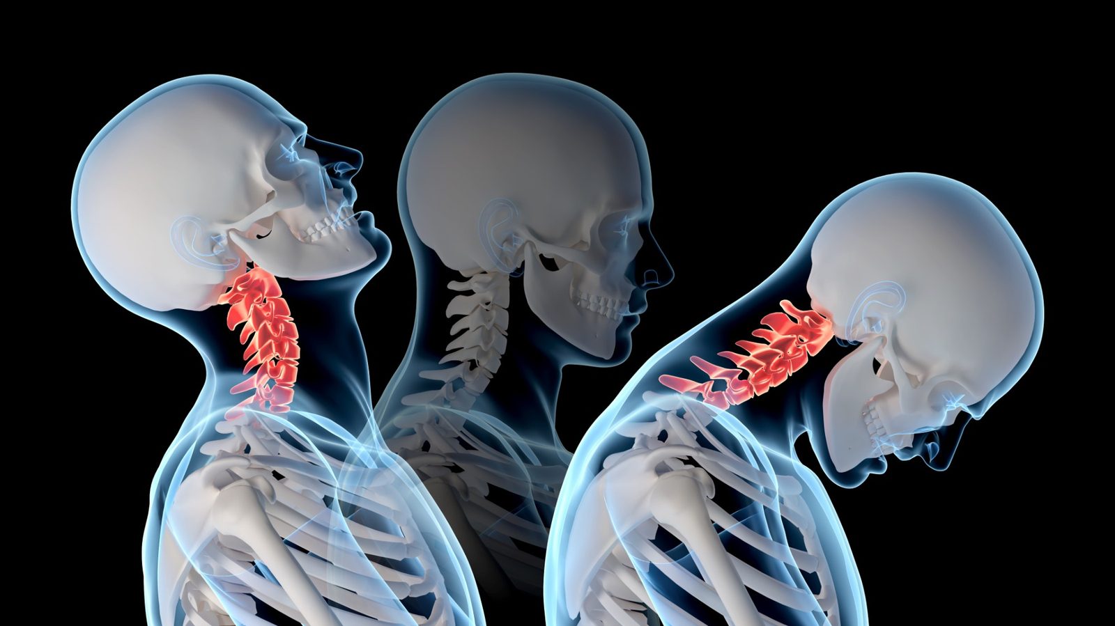 Three side views of the head and neck during a rear-end impact: the neck forced backward with the cervical spine highlighted, the neutral position, and the head whipping forward.