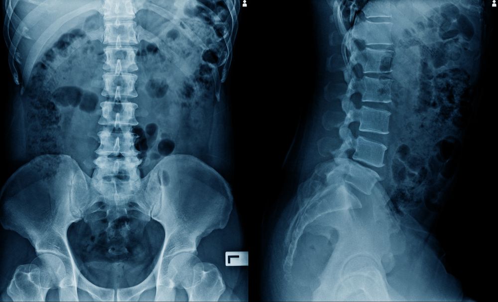 Front and side X-ray views of a lumbar spine and pelvis.