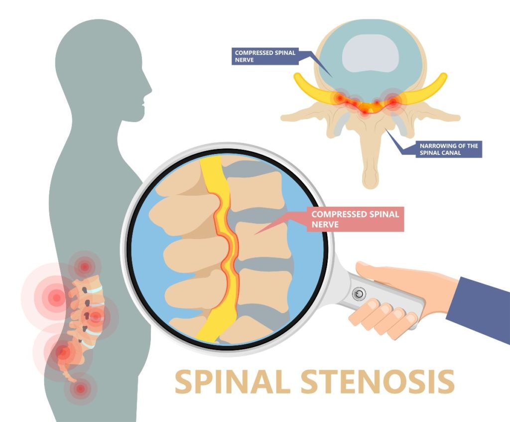 Non-Surgical Treatment for Spinal Stenosis - Huffman Spine Clinic - spinal  stenosis